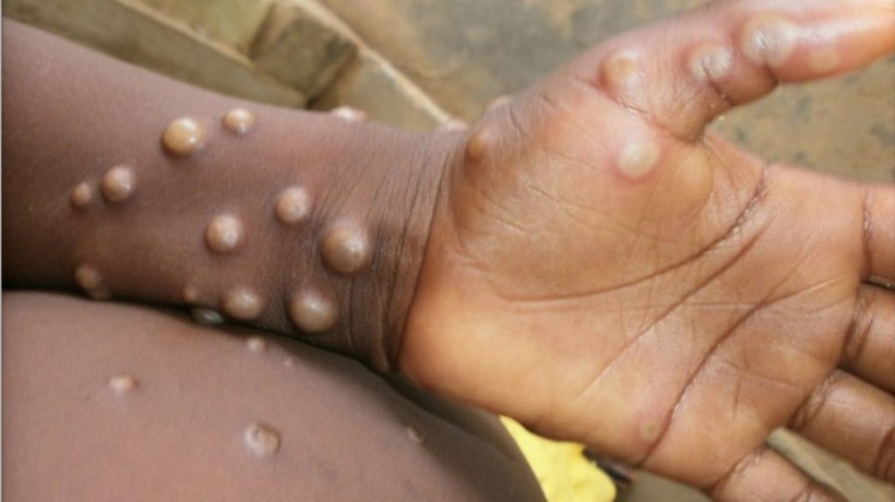 África pide declaración de emergencia de salud pública por brote de mpox