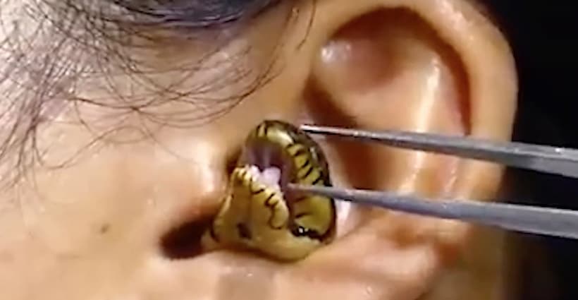¡¿De dónde?!: Extraen una víbora viva de la oreja de una mujer