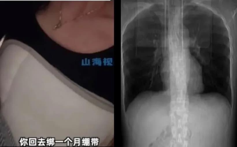 VIRAL: Mujer se rompe las costillas por toser muy fuerte; ocurrió en China
