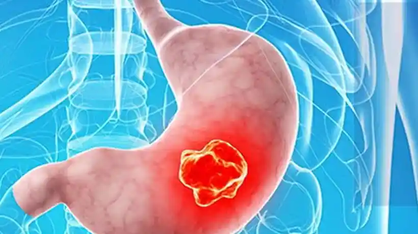 Cáncer de estómago: síntomas, factores de riesgo y prevención